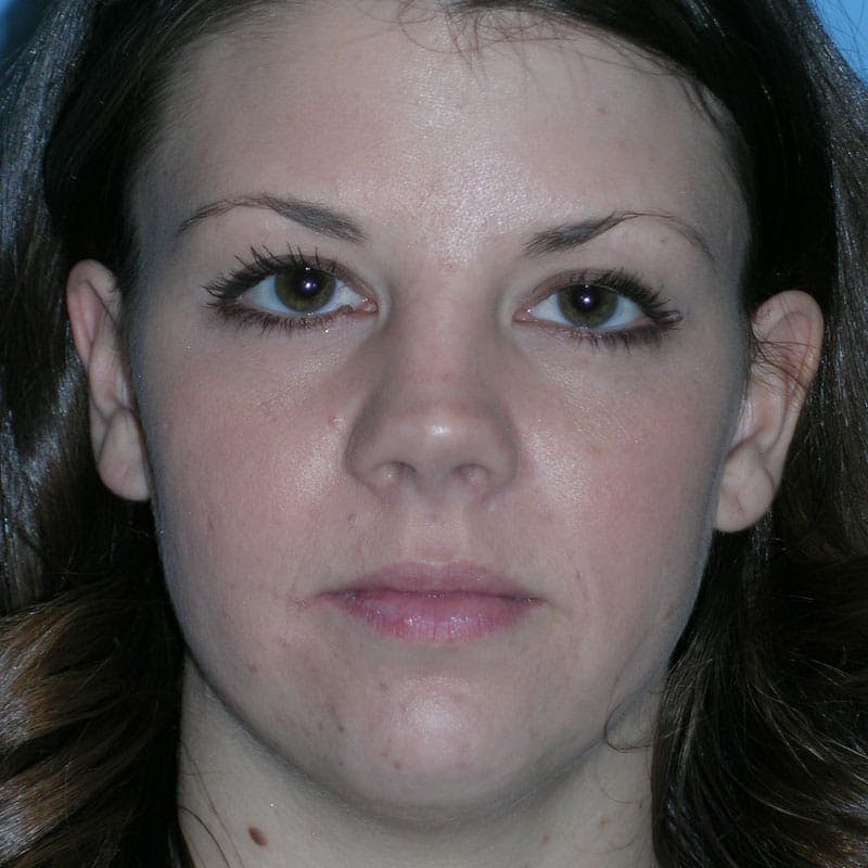 Short Nose Before & After Gallery - Patient 597359 - Image 1