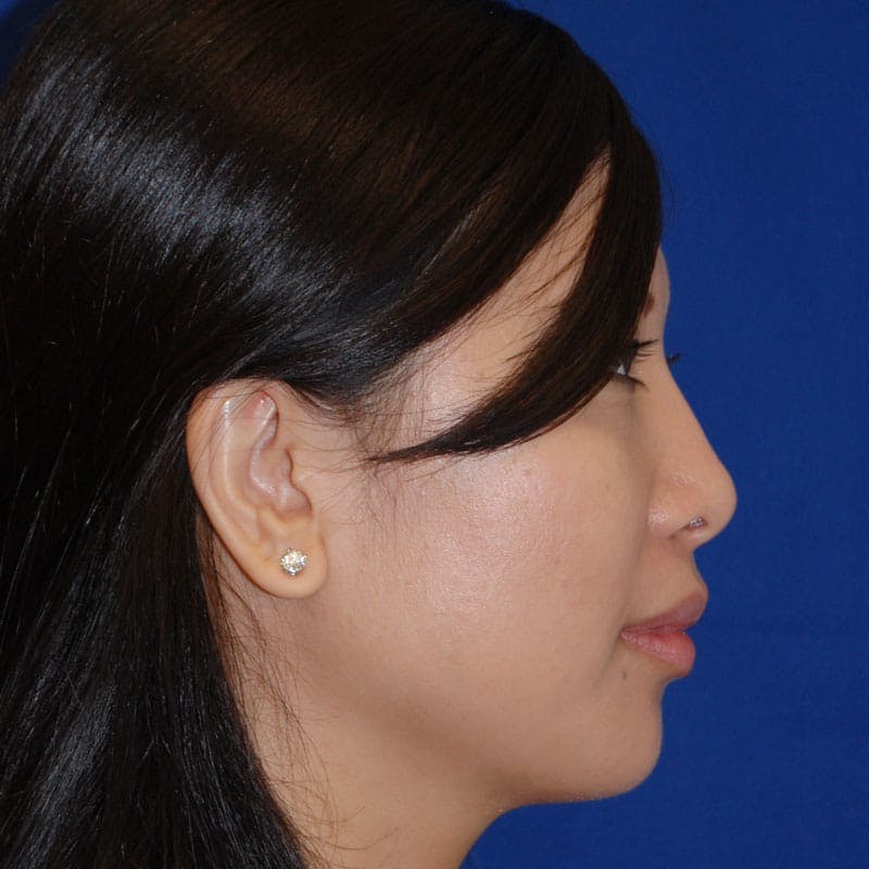 Short Nose Before & After Gallery - Patient 288711 - Image 6