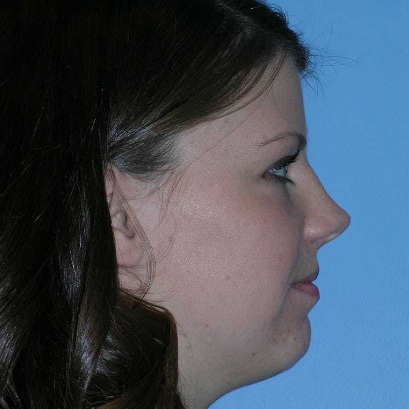 Short Nose Before & After Gallery - Patient 597359 - Image 5