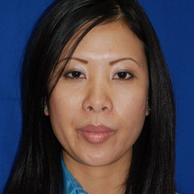 Short Nose Before & After Gallery - Patient 288711 - Image 1