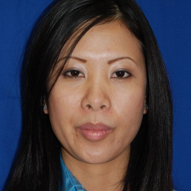 Short Nose Before & After Gallery - Patient 288711 - Image 1