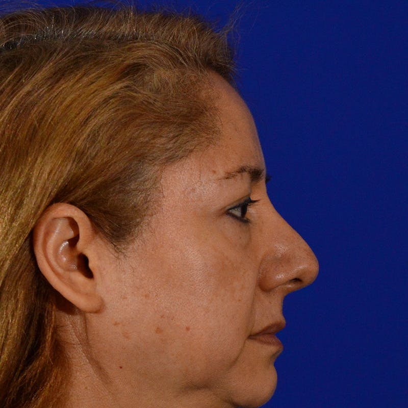 Brow Lift Before & After Gallery - Patient 361801 - Image 3