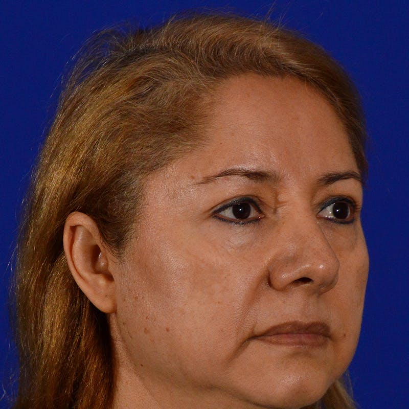 Brow Lift Before & After Gallery - Patient 361801 - Image 5