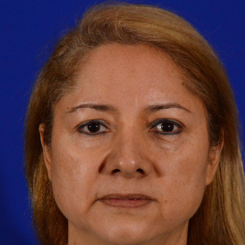 Brow Lift Before & After Gallery - Patient 361801 - Image 1