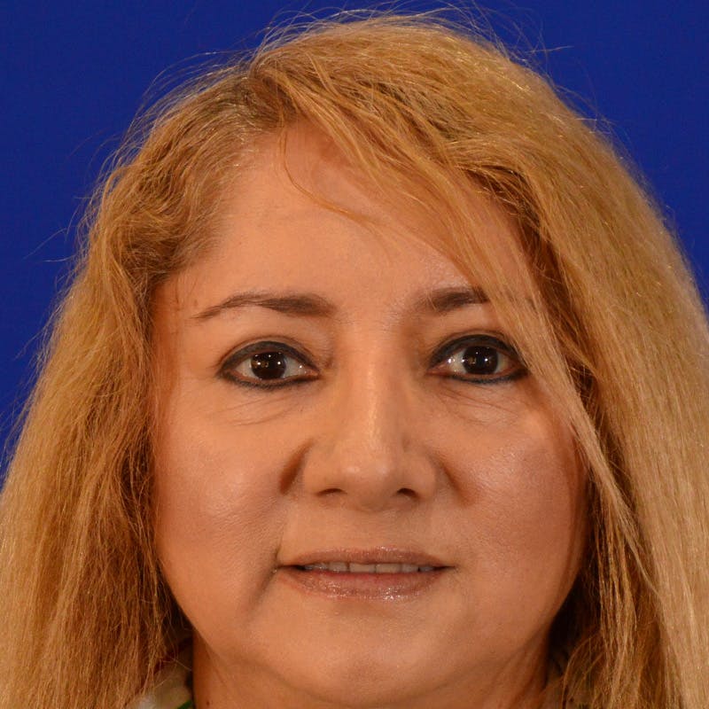 Brow Lift Before & After Gallery - Patient 361801 - Image 2