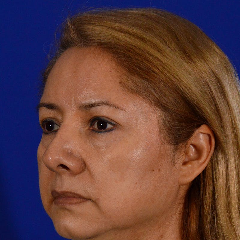 Brow Lift Before & After Gallery - Patient 361801 - Image 7