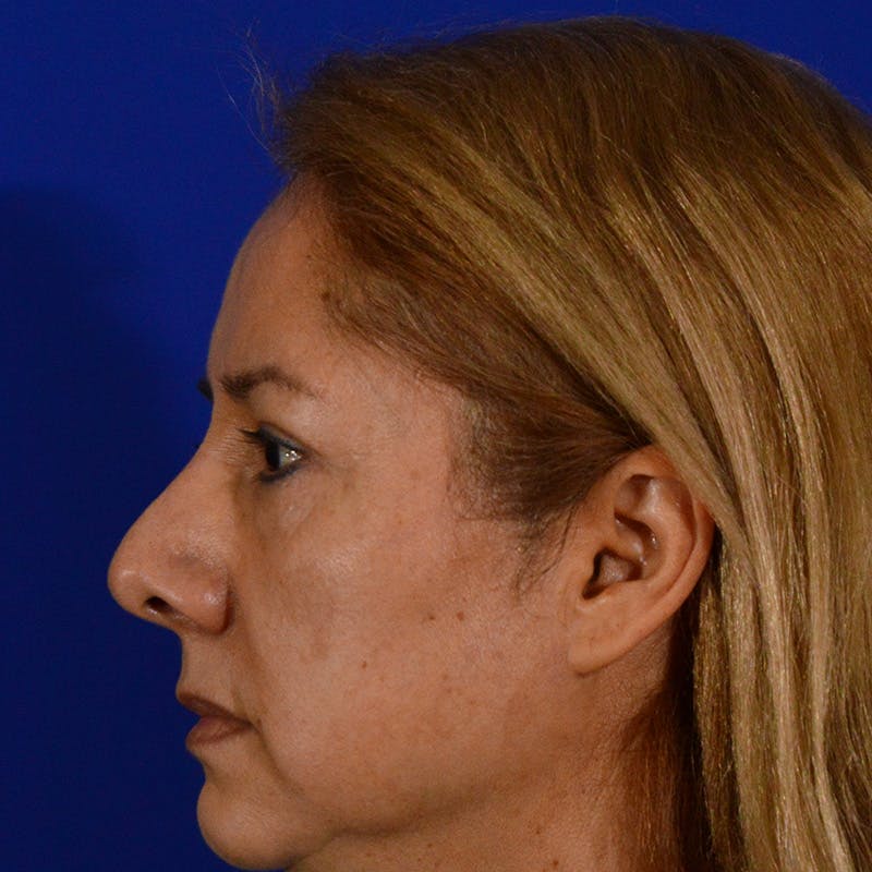 Brow Lift Before & After Gallery - Patient 361801 - Image 9