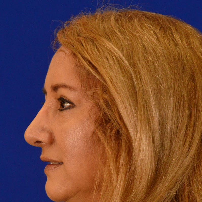 Brow Lift Before & After Gallery - Patient 361801 - Image 10