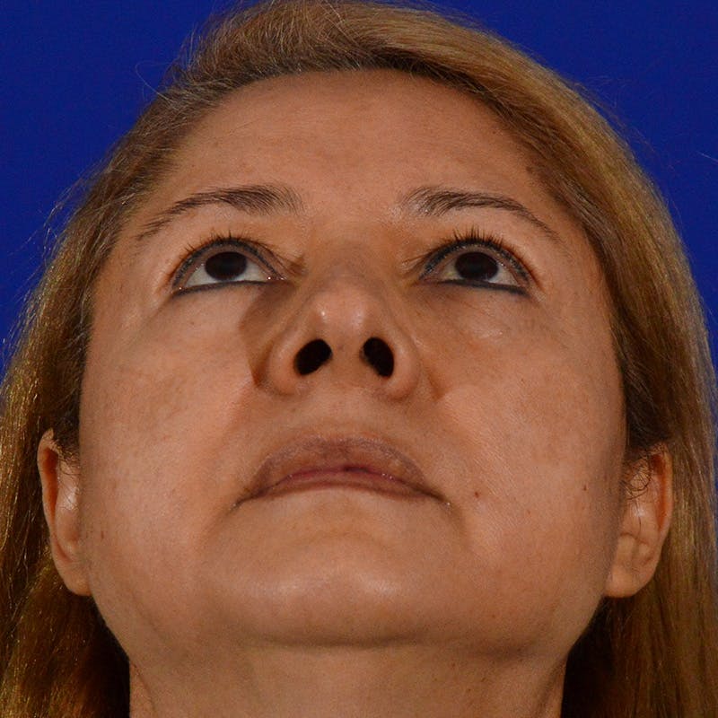 Brow Lift Before & After Gallery - Patient 361801 - Image 11