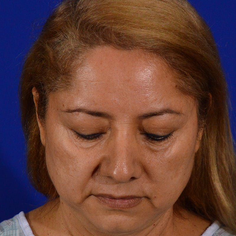 Brow Lift Before & After Gallery - Patient 361801 - Image 13