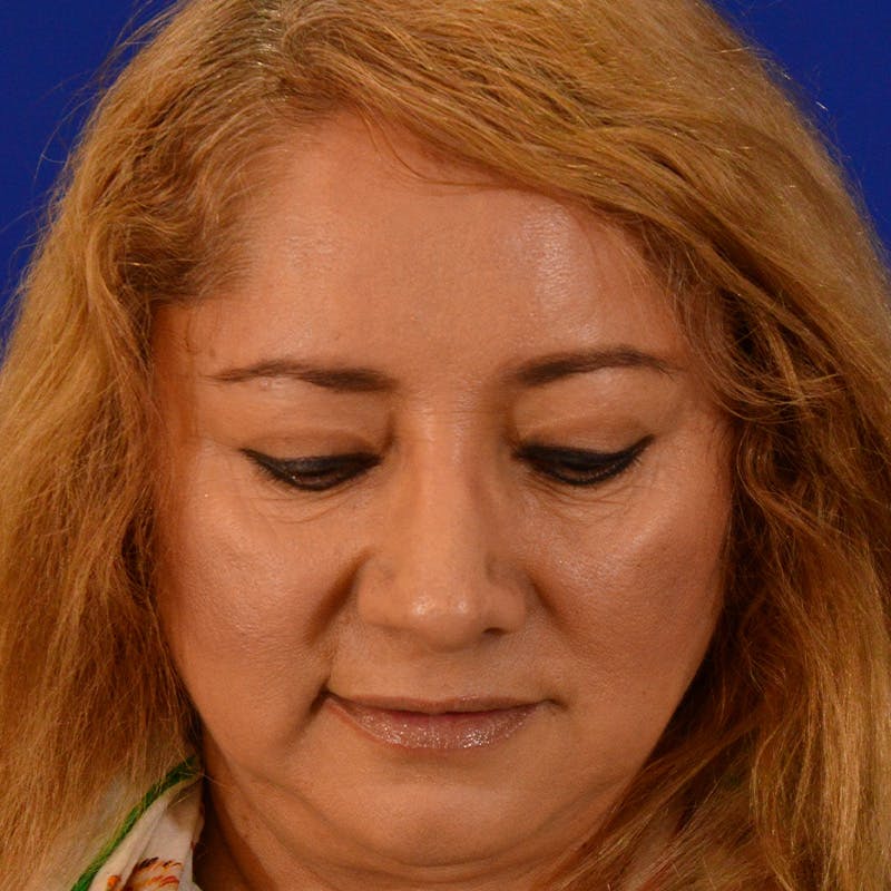 Brow Lift Before & After Gallery - Patient 361801 - Image 14