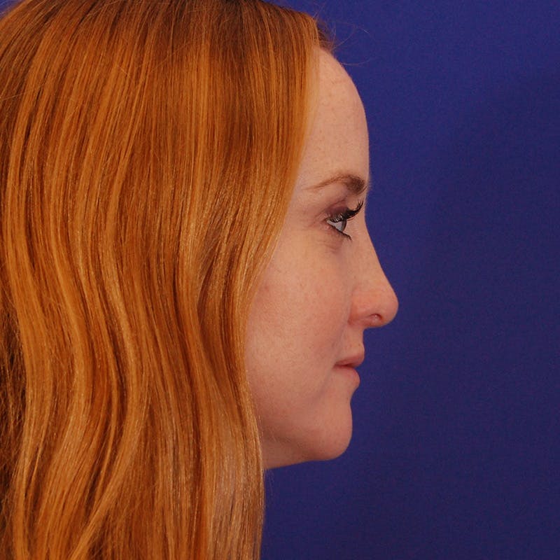 Revision Rhinoplasty Before & After Gallery - Patient 398239 - Image 4