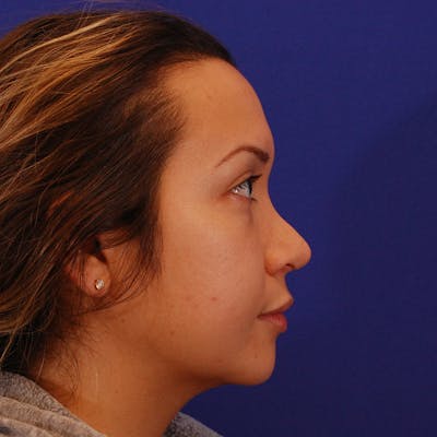 Revision Rhinoplasty Before & After Gallery - Patient 563713 - Image 1