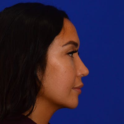 Revision Rhinoplasty Before & After Gallery - Patient 563713 - Image 2