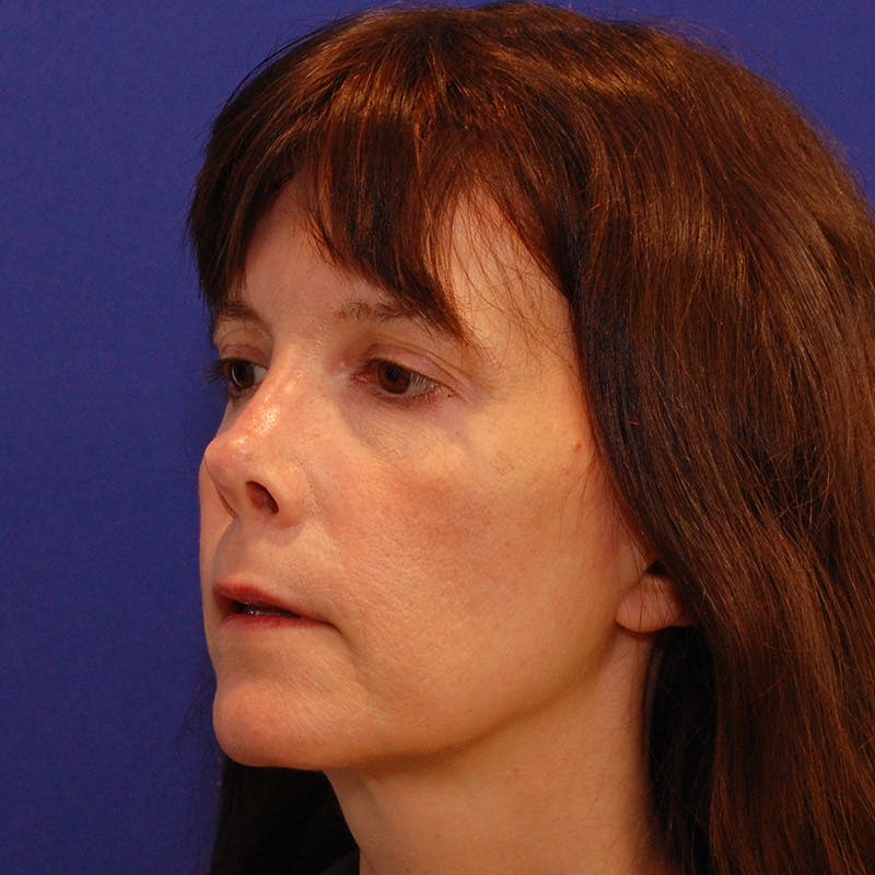 Revision Rhinoplasty Before & After Gallery - Patient 410283 - Image 7