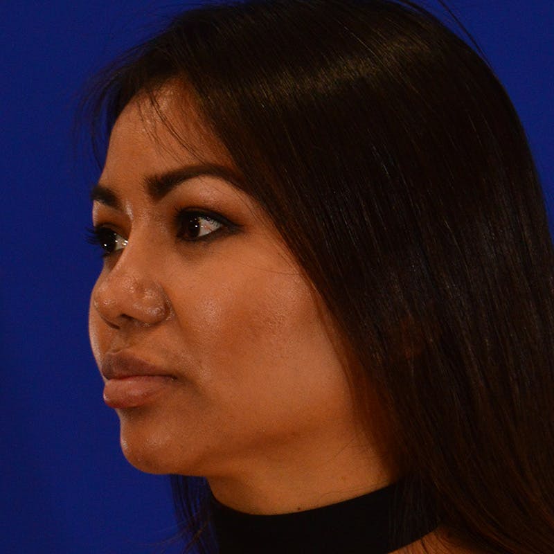 Revision Rhinoplasty Before & After Gallery - Patient 235432 - Image 8