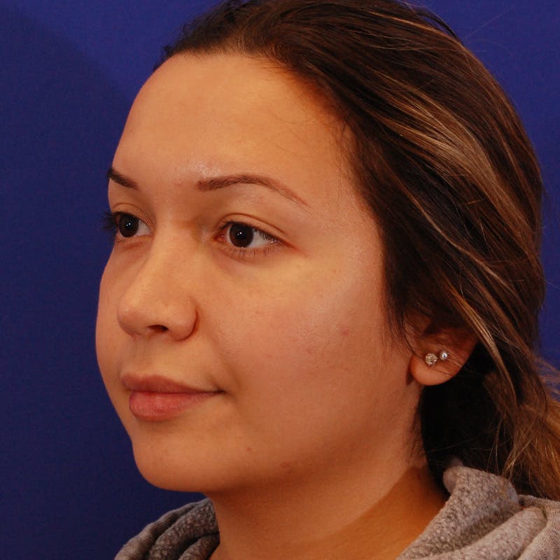 Wide Nose Before & After Gallery - Patient 758815 - Image 7