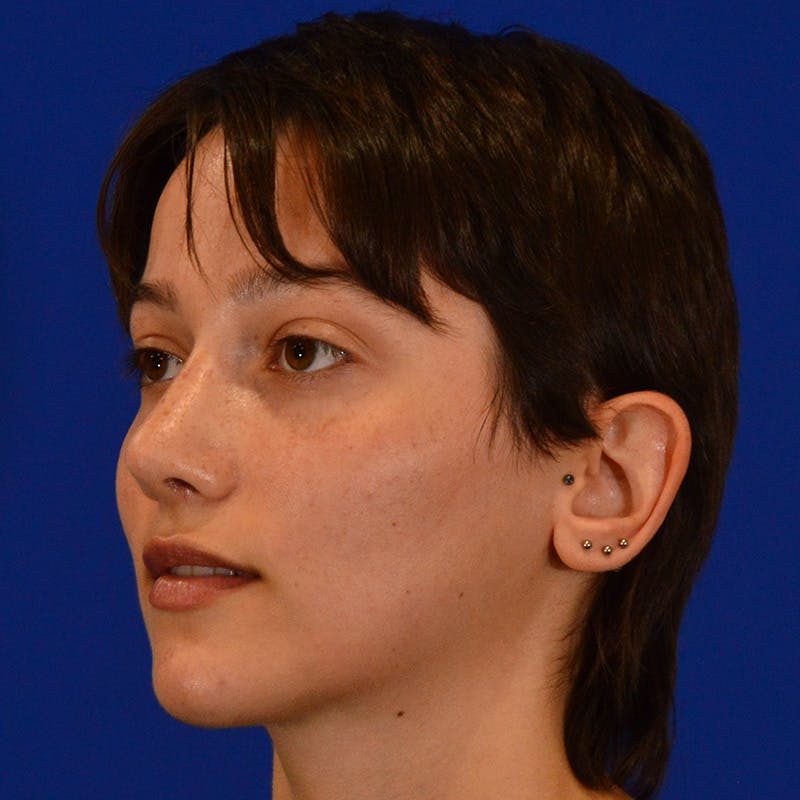Revision Rhinoplasty Before & After Gallery - Patient 137431 - Image 8