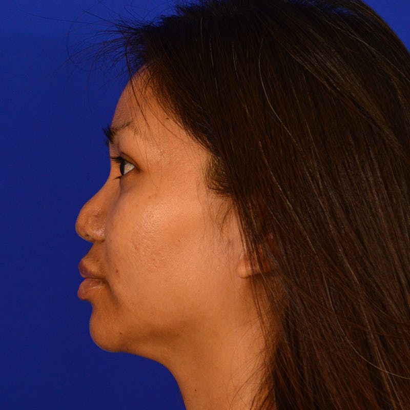 Revision Rhinoplasty Before & After Gallery - Patient 235432 - Image 9