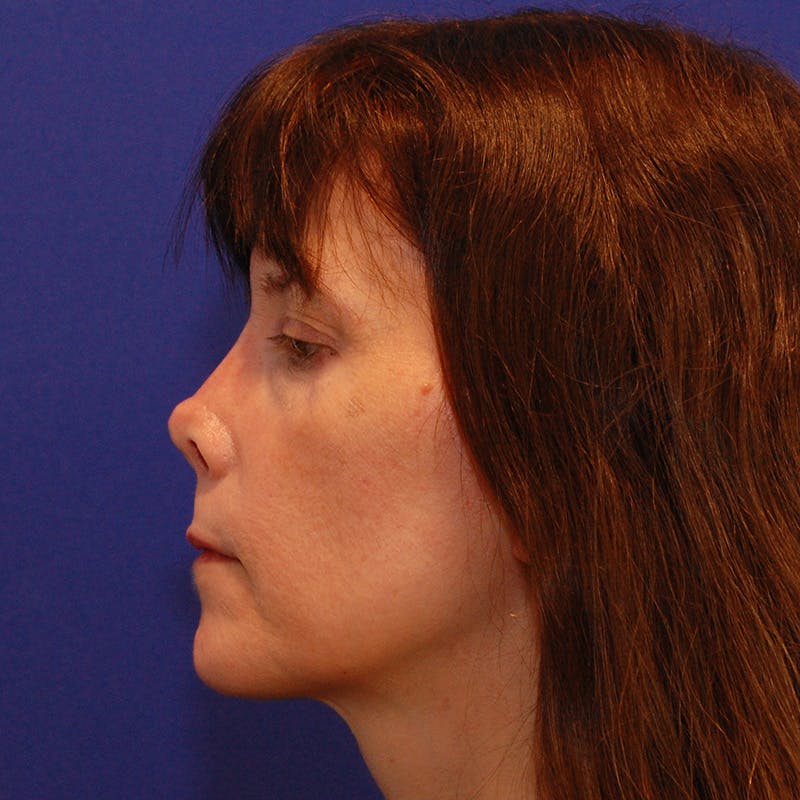 Revision Rhinoplasty Before & After Gallery - Patient 410283 - Image 9