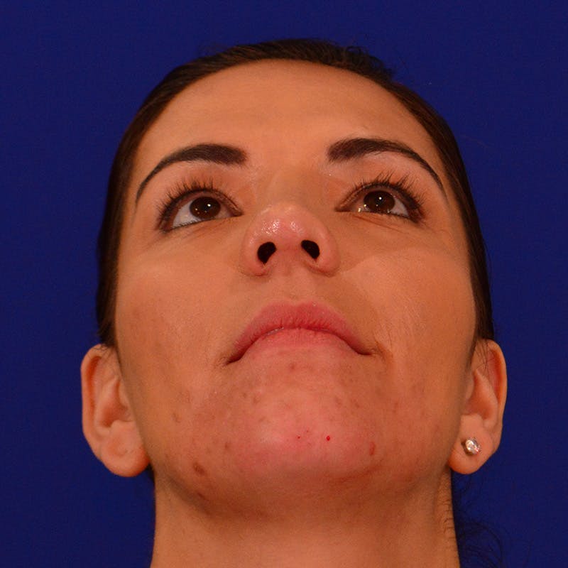 Chin Augmentation Before & After Gallery - Patient 287872 - Image 12