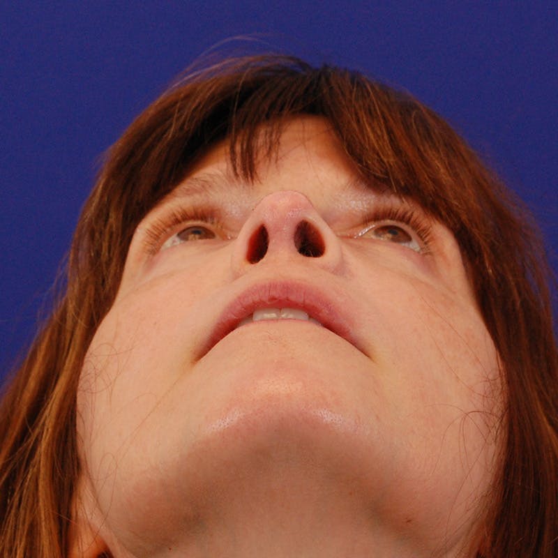 Revision Rhinoplasty Before & After Gallery - Patient 410283 - Image 14