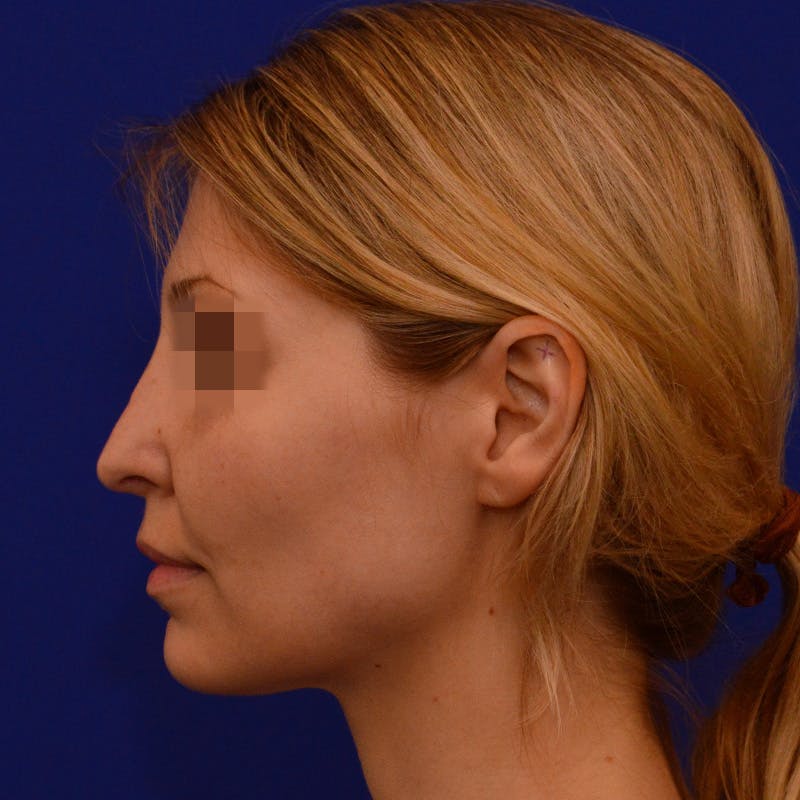 Revision Rhinoplasty Before & After Gallery - Patient 279186 - Image 3
