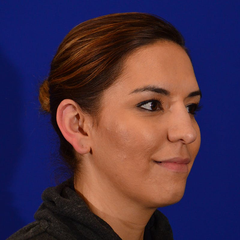 Chin Augmentation Before & After Gallery - Patient 287872 - Image 3