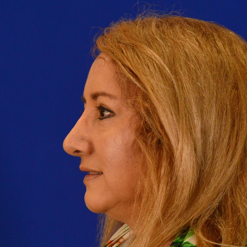 Revision Rhinoplasty Before & After Gallery - Patient 197355 - Image 10