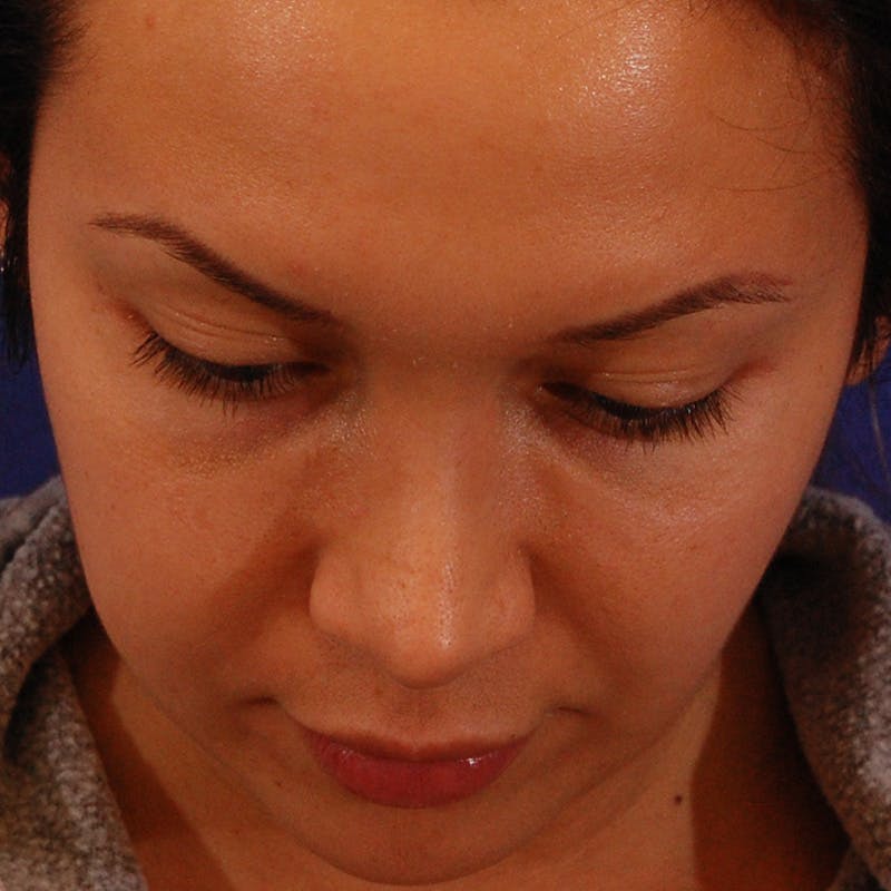 Wide Nose Before & After Gallery - Patient 758815 - Image 13