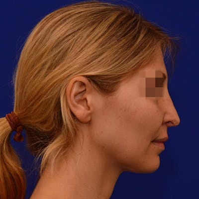 Revision Rhinoplasty Before & After Gallery - Patient 279186 - Image 1