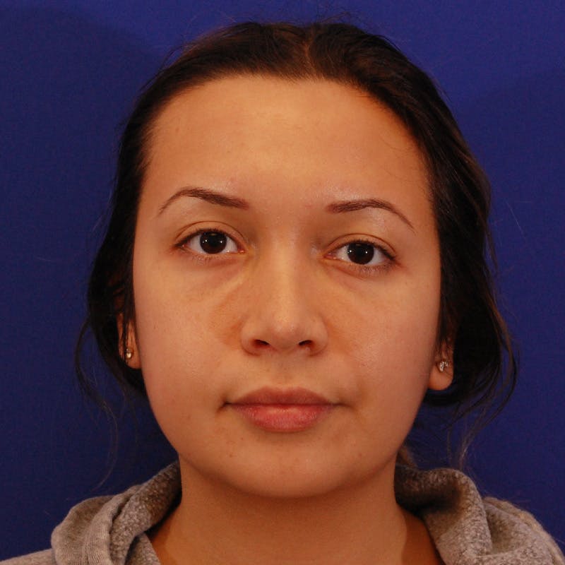 Wide Nose Before & After Gallery - Patient 758815 - Image 1