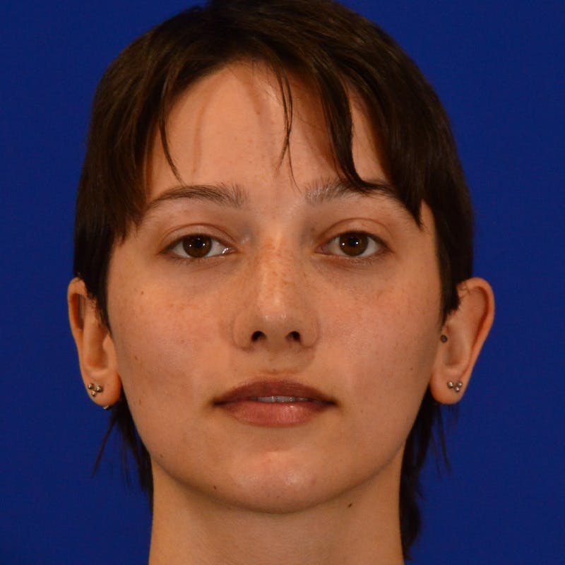 Revision Rhinoplasty Before & After Gallery - Patient 137431 - Image 6