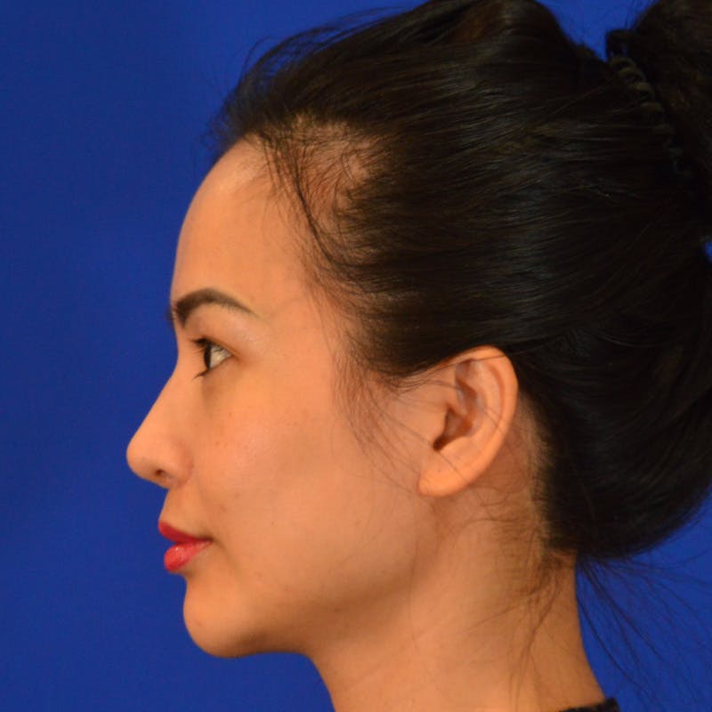 Revision Rhinoplasty Before & After Gallery - Patient 132405 - Image 10