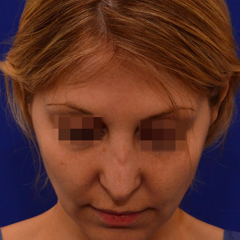 Revision Rhinoplasty Before & After Gallery - Patient 279186 - Image 11