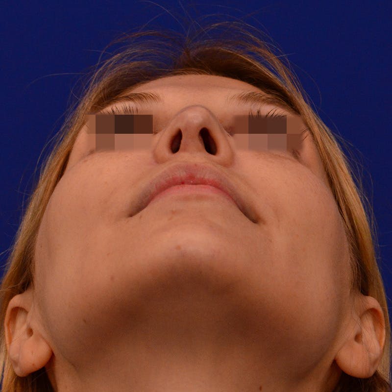 Revision Rhinoplasty Before & After Gallery - Patient 279186 - Image 15