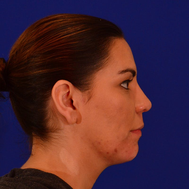 Chin Augmentation Before & After Gallery - Patient 287872 - Image 6
