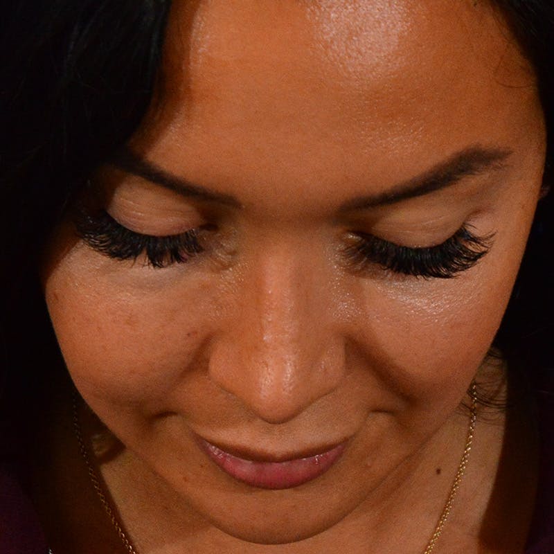 Wide Nose Before & After Gallery - Patient 758815 - Image 14