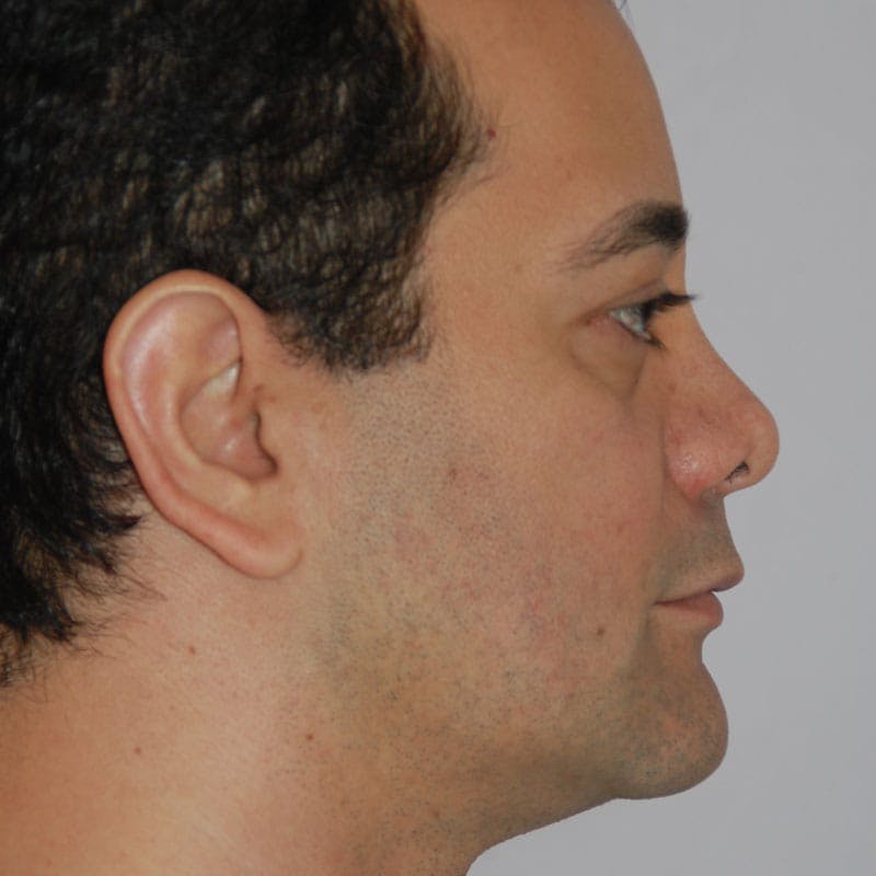 Revision Rhinoplasty Before & After Gallery - Patient 617931 - Image 1