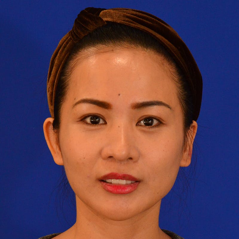 Revision Rhinoplasty Before & After Gallery - Patient 132405 - Image 5