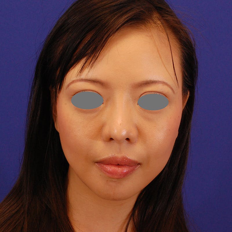 Revision Rhinoplasty Before & After Gallery - Patient 654727 - Image 3