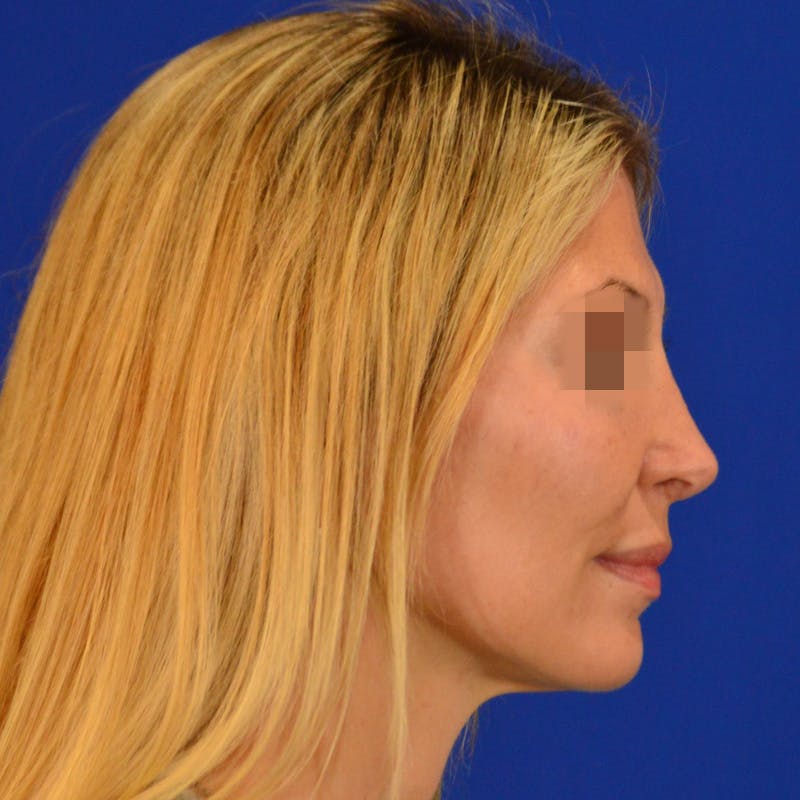 Revision Rhinoplasty Before & After Gallery - Patient 279186 - Image 2