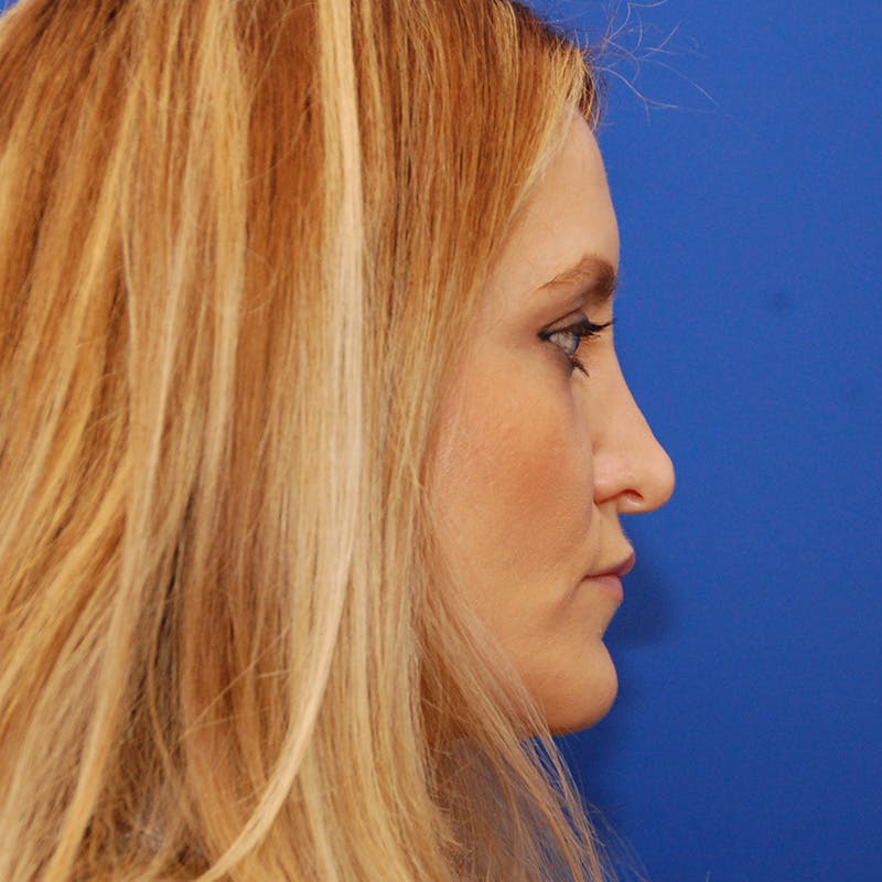 Revision Rhinoplasty Before & After Gallery - Patient 151352 - Image 1