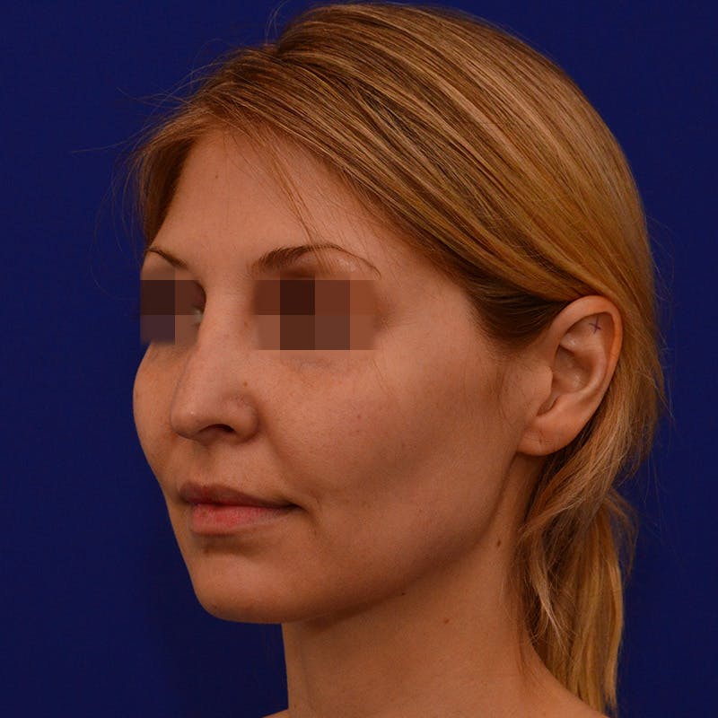 Revision Rhinoplasty Before & After Gallery - Patient 279186 - Image 5