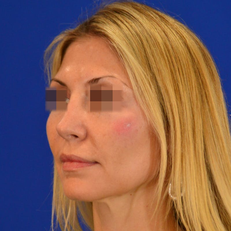 Revision Rhinoplasty Before & After Gallery - Patient 279186 - Image 6