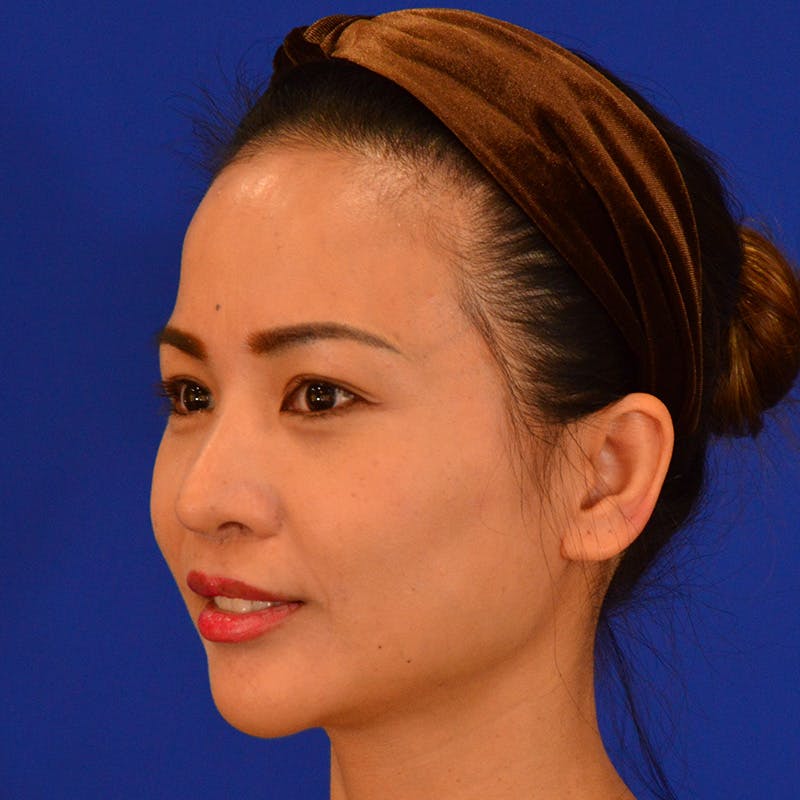 Revision Rhinoplasty Before & After Gallery - Patient 132405 - Image 7