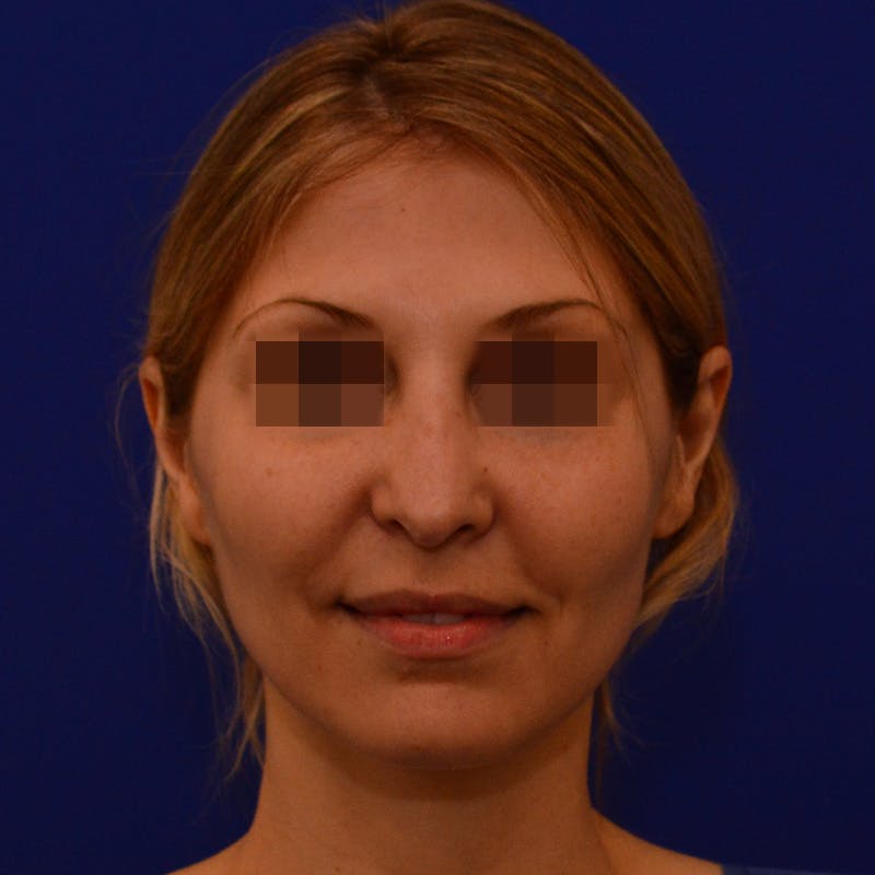 Revision Rhinoplasty Before & After Gallery - Patient 279186 - Image 7