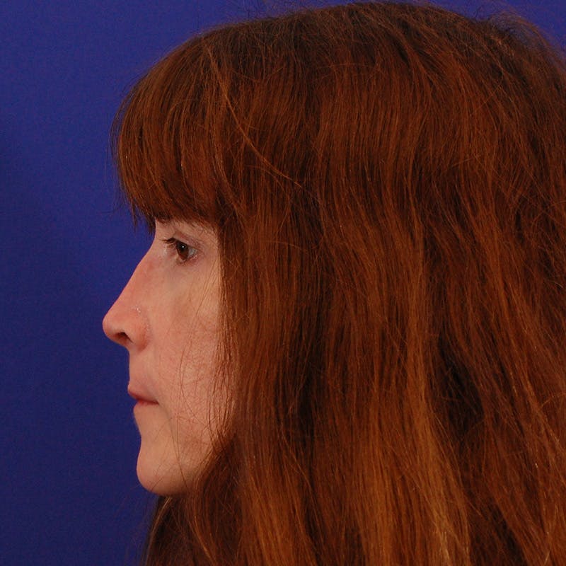 Revision Rhinoplasty Before & After Gallery - Patient 410283 - Image 10