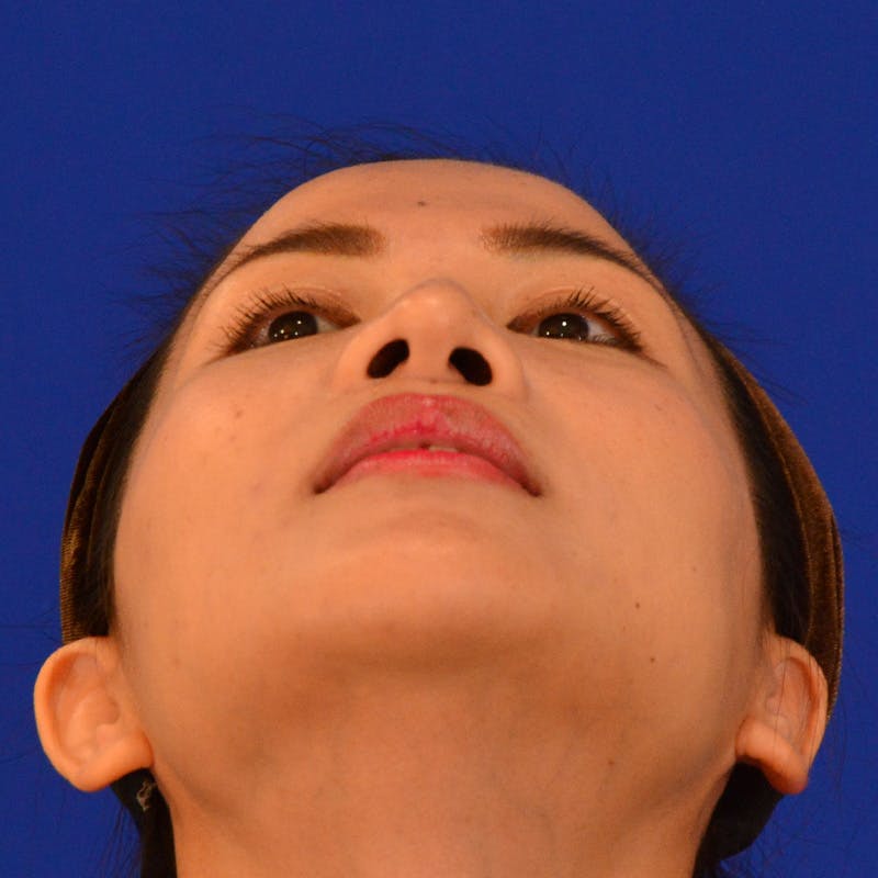 Revision Rhinoplasty Before & After Gallery - Patient 132405 - Image 11