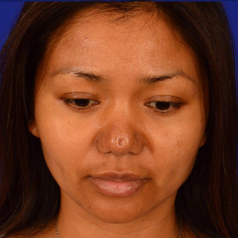 Revision Rhinoplasty Before & After Gallery - Patient 235432 - Image 13